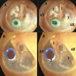 chambre implantable chambre implantable