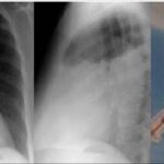 hemothorax a9961a687.jpg1746978031
