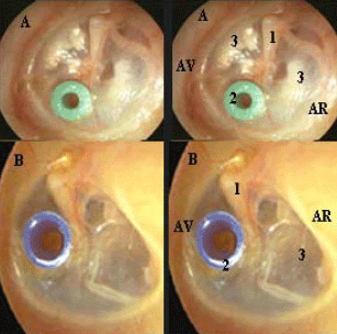 aerateur trans tympanique anatomie oreille