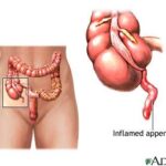 appendicite anatomie colon