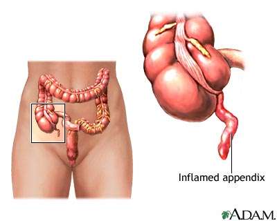 appendicite anatomie colon