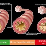 asthme anatomie arbre tracheo broncho pulmonaire vu de face