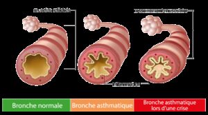 asthme anatomie arbre tracheo broncho pulmonaire vu de face