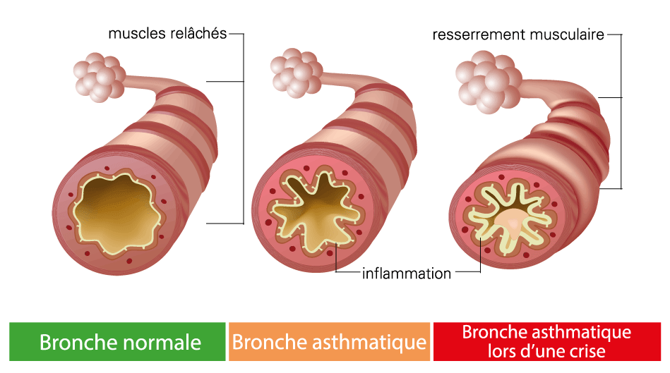 asthme anatomie arbre tracheo broncho pulmonaire vu de face