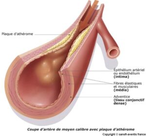 atherome