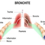bronchite aigue anatomie arbre tracheo broncho pulmonaire vu de face