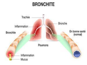 bronchite aigue anatomie arbre tracheo broncho pulmonaire vu de face