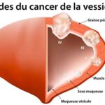 cancer de la vessie anatomie vessie pleine coupe vue de face