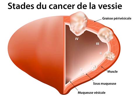 cancer de la vessie anatomie vessie pleine coupe vue de face