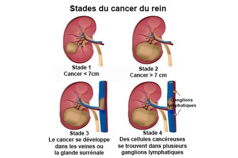 cancer du rein anatomie coupe sagittale du rein gauche