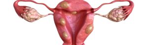 cancer endometre anatomie appareil genital feminin