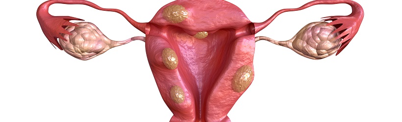 cancer endometre anatomie appareil genital feminin