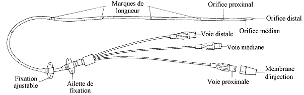 catheter veineux central 1