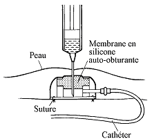 chambre catheter implantable