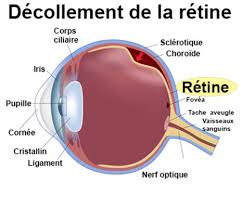 decollement de la retine anatomie coupe oeil