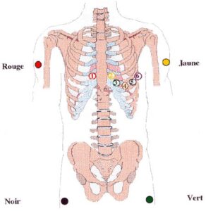 ecg electrode