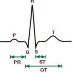 ecg trace