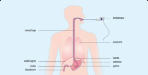 endoscopie voie haute anatomie voies digestives superieures