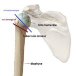 fracture de la tete humerale anatomie epaule