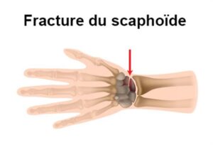 fracture du scaphoide anatomie main