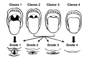 intubation tracheale classes mallampati