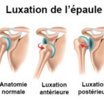 luxation epaule anatomie articulation