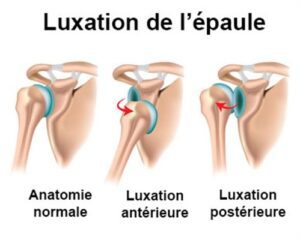 luxation epaule anatomie articulation