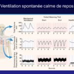 modes ventilatoires ventilation spontanee