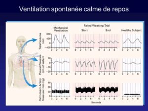 modes ventilatoires ventilation spontanee