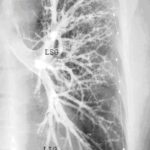 pneumonie anatomie arbre tracheo broncho pulmonaire vu de face