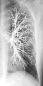 pneumonie anatomie arbre tracheo broncho pulmonaire vu de face