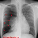 pneumothorax poumons sains
