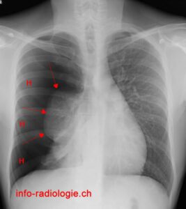 pneumothorax poumons sains