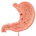 ulcere gastrique anatomie coupe estomac
